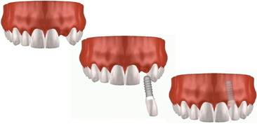 インプラントによる治療