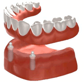 総入れ歯をボールアンカーで２本のインプラントに固定した場合