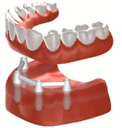 総入れ歯をバー構造を取り付けた４本のインプラントに固定する場合