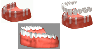 ８本のインプラントで固定されている義歯